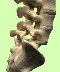 spondylolysis car accident